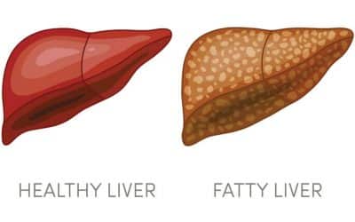 ফ্যাটি লিভার – কারণ, লক্ষণ ও কমানোর উপায়