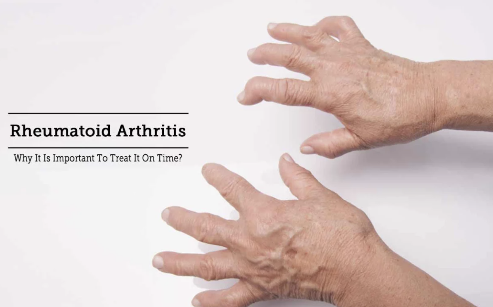 Rheumatoid Arthritis Treatment - Dr. Debabrata Sarkar