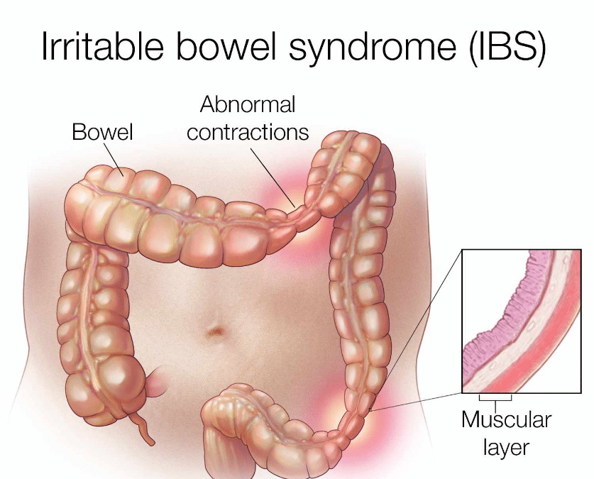 আইবিএস (IBS – Irritable Bowel Syndrome) – কারণ, লক্ষণ ও কমানোর উপায়