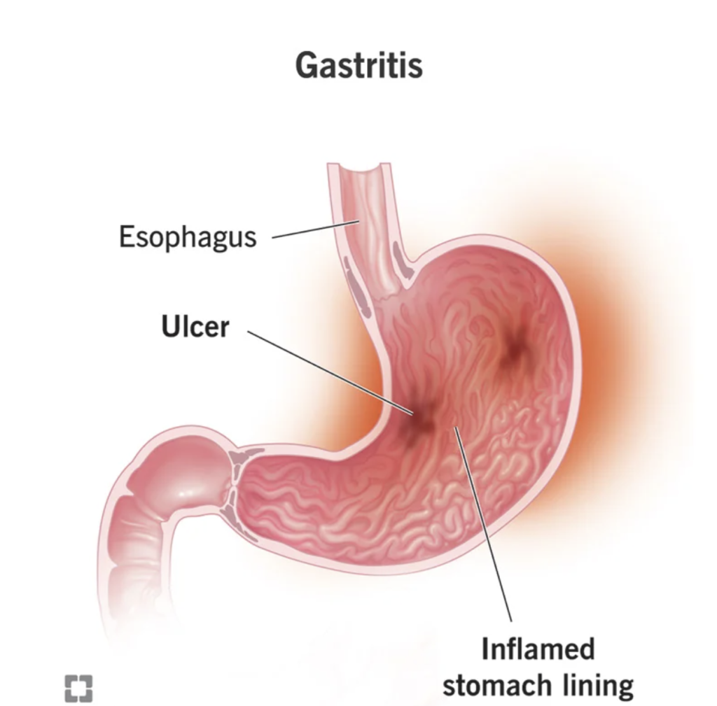 Gastritis treatment - Dr. Debabrata Sarkar