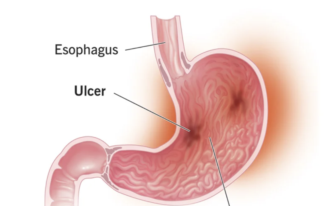 Gastritis treatment - Dr. Debabrata Sarkar