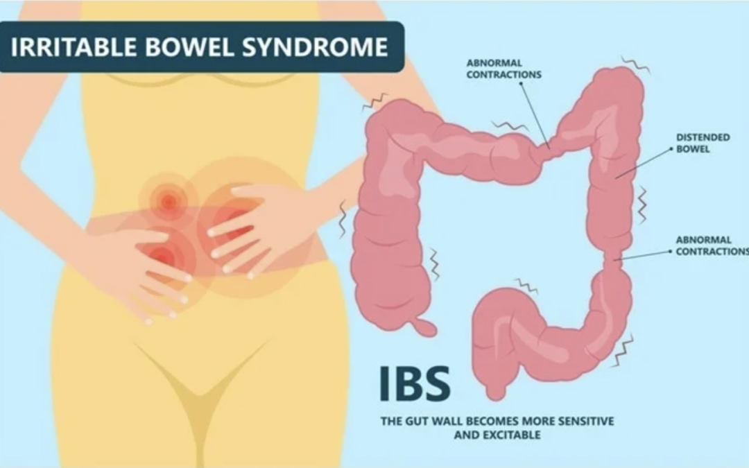 IBS treatment